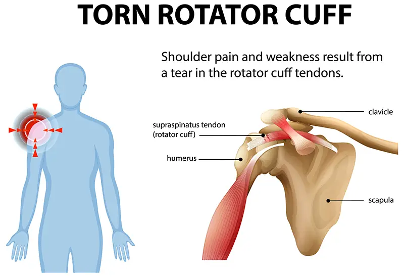 Torn rotator cuff illustration